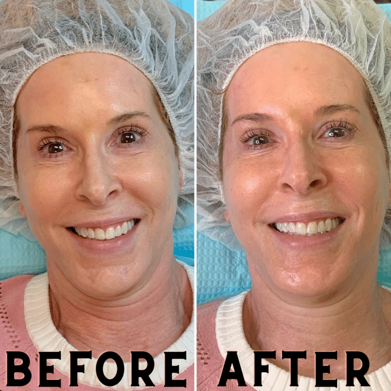 Woman over 50 Hydrafacial Before & After photo