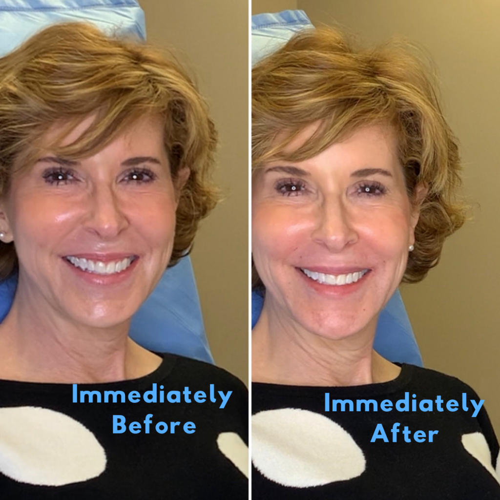 before and after photo of a woman over 50 who had dermal filler in her nasolabial folds chin and lips