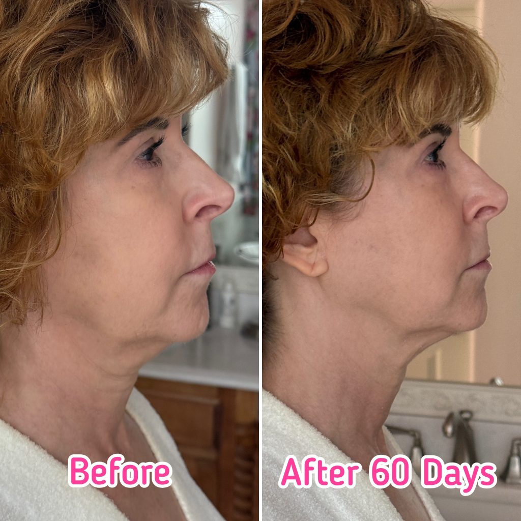 woman showing results after using nira pro laser for 60 days