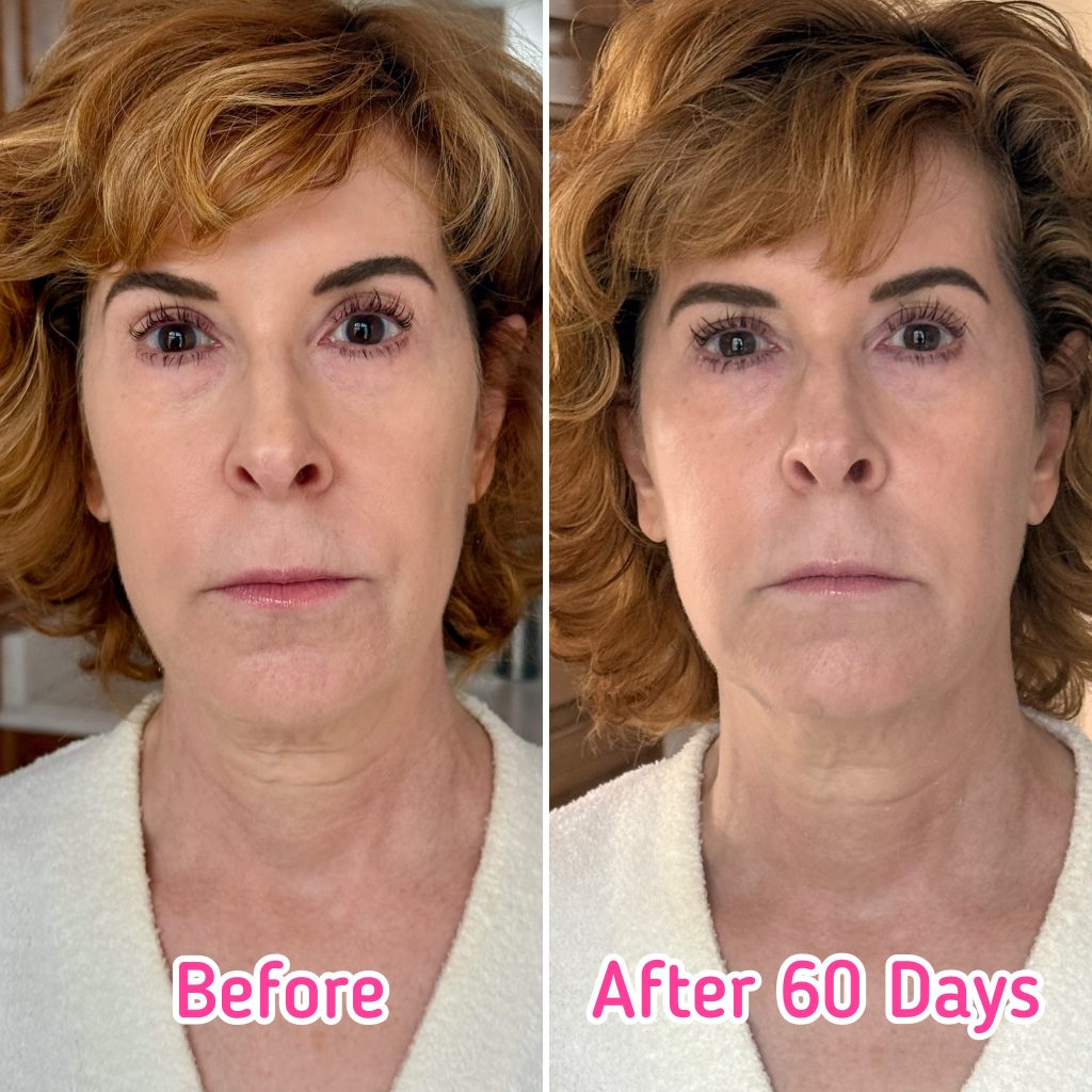 woman showing results after using nira pro laser for 60 days