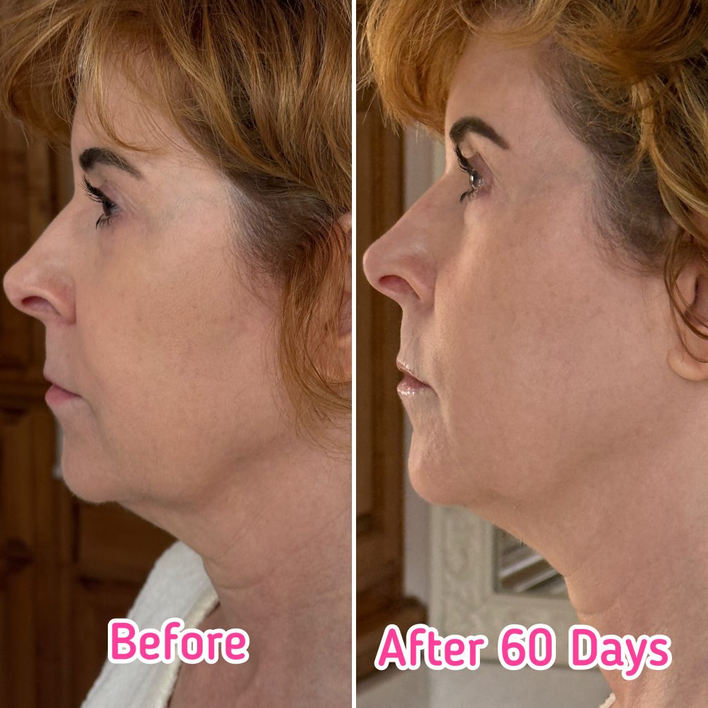 woman showing results after using nira pro laser for 60 days