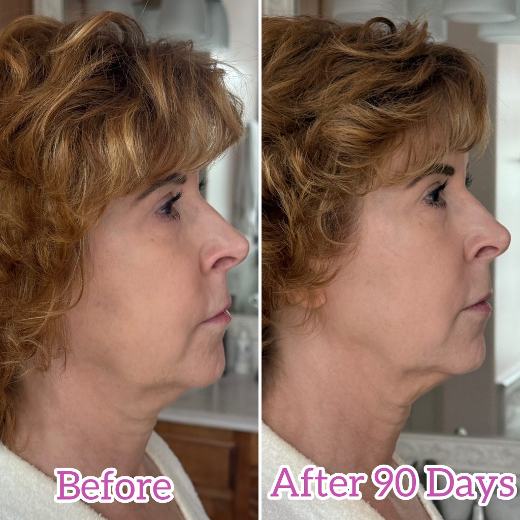 before and after photos with nira pro laser - 90 days