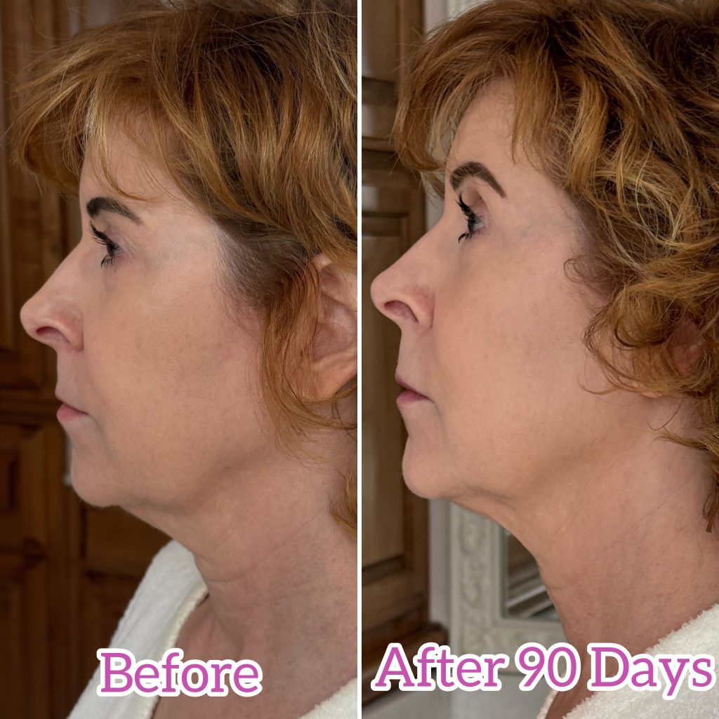 before and after photos with nira pro laser - 90 days