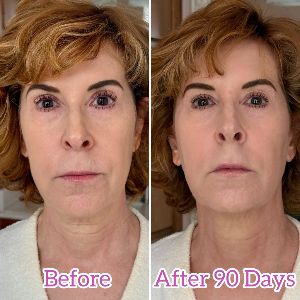before and after photos with nira pro laser - 90 days